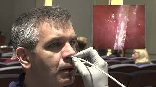 nasopharyngeal laryngoscopy Original [upl. by Aitsirk]