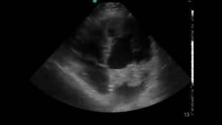 Atrial Myxoma Ultrasound JETem [upl. by Braca]