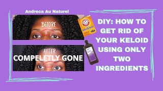 DIY How to Get Rid of Your Keloid Using Only TWO Ingredients [upl. by Walls498]