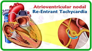 Atrioventricular nodal reentrant tachycardia AVNRT  USMLE [upl. by Naanac]