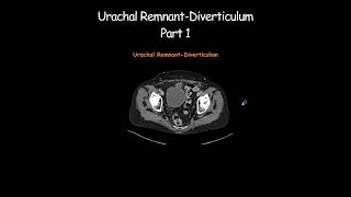 Urachal RemnantDiverticulum Part 1 radiology radiologist embryology urinarybladder [upl. by Assyla]