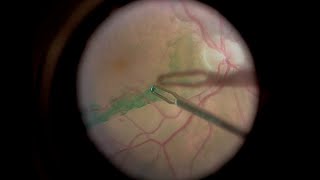 EPIRETINAL MEMBRANE [upl. by Ayimat837]