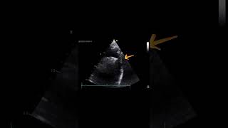 ⚠️COARTACIÓN AÓRTICA Caso ECOCARDIOGRAMA [upl. by Kaslik109]