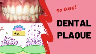 Dental Plaque  Types and Formation [upl. by Yenalem300]