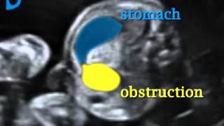 Fetal Medicine Foundation  Duodenal stenosis [upl. by Ellerihs]