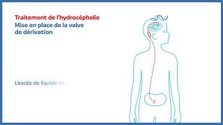 Hydrocéphalie  valve de dérivation peritonéale [upl. by Suk232]