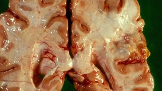 Cerebral Ischaemia and Infarction  Pathology mini tutorial [upl. by Cicenia]