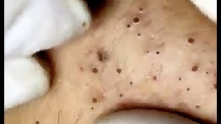 Amazing Blackheads just wait for it [upl. by Kristofor]