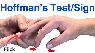 How to Perform a Hoffmans Test  Inverted Supinator Sign  Clonus  Hyperreflexia [upl. by Sheilah762]