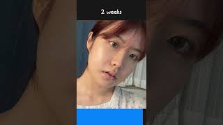 Double Jaw Surgery in Korea Before amp After 3 months post op [upl. by Imef210]