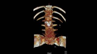 L45 spondylolytic spondylolisthesis [upl. by Blain]