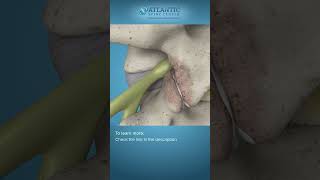 What is Endoscopic Lumbar Foraminotomy Shorts Atlantic Spine Center [upl. by Eyk]