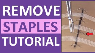 Surgical Staple Removal Nursing  How to Remove Surgical Staples [upl. by Cordie]