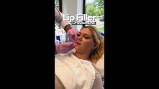 Lip Filler Live Demo ✨ [upl. by Neela999]