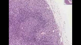 Histopathology Lymph nodeNodal marginal zone Bcell lympho [upl. by Sivrat]