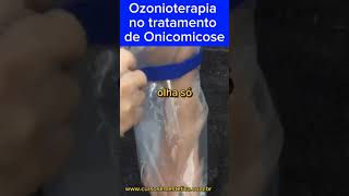 Ozonioterapia no tratamento de Onicomicose [upl. by Ekralc]