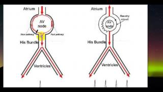 1  Cơ chế cơn AVNRT [upl. by Aihsinyt876]