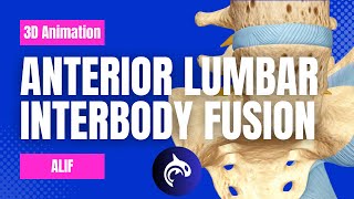 Anterior Lumbar Interbody Fusion ALIF  3D Animation [upl. by Dyraj]