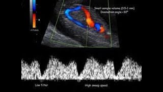 Ductus Venosus  Ultrasound [upl. by Anits]