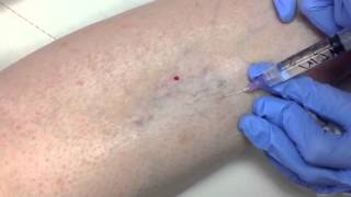 Sclerotherapy [upl. by Simmonds]