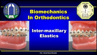 Intermaxillary Elastics in Orthodontics [upl. by Belinda132]