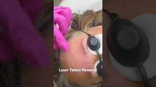 Is laser tattoo removal safe for eyebrows [upl. by Annoet]