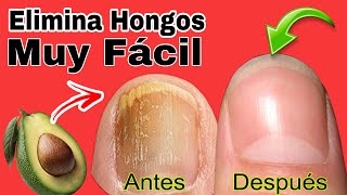 COMO Eliminar HONGOS de las UÑAS usando AGUACATE [upl. by Files]