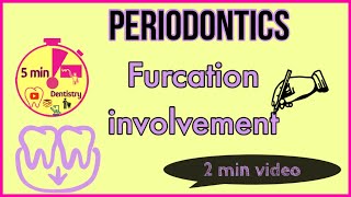 FURCATION INVOLVEMENT  Glickmans classification in 2 minutes  Periodontics [upl. by Acissaj905]