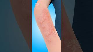 Hives What Happens Inside Your Body 😮 shorts urticaria  Creativelearning3d [upl. by Lachish]