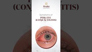 Symptoms of conjunctivitis  Dr Abdul Rasheed  dryeye itchyeyes eyesburning conjunctivitis [upl. by Janine295]