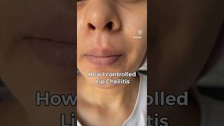 Lip Cheilitis  Lip disease that looks like very dry chapped lips but ITS NOT cheilitis [upl. by Halyahs]