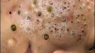 Huge blackhead removal from face  blackheads new this week 2024 [upl. by Peterson]