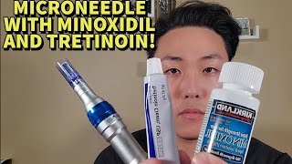 HOW TO MICRONEEDLE WITH MINOXIDIL AND TRETINOIN FOR MAXIMUM HAIR GROWTH STEP BY STEP GUIDE [upl. by Hannasus]