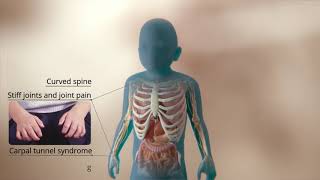 An Inside look at Mucopolysaccharidosis Type I MPS I [upl. by Anitnoc]