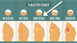 How To Treat A Blister Correctly First Look At Your Blister Roof [upl. by Anir777]