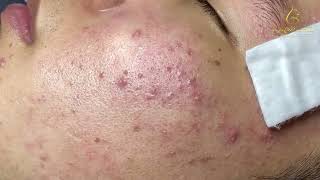 Loan Nguyen Acne Treatment 171333 [upl. by Rosenblum]