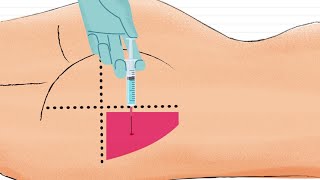 Como Aplicar Inyección Intramuscular en el GLUTEO 🍑 [upl. by Clem513]