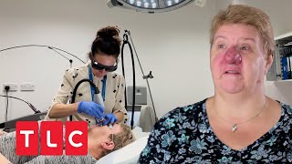 Große knollige und rote Nase  Dr Emma  Hautärztin aus Leidenschaft  TLC Deutschland [upl. by Carver]