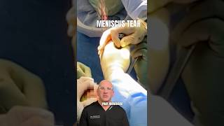 Shocking Truth Life Without a Meniscus shorts [upl. by Yesmar238]