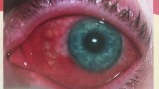 What is Conjunctivitis Lecture Notes [upl. by Belita]