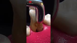 Extraccion dental en 4k shorts [upl. by Aligna]