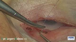 Inferior retractor plication conjunctival approach technique 2 [upl. by Siahc]