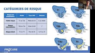 Tout sur la radiothérapie [upl. by Eerihs]