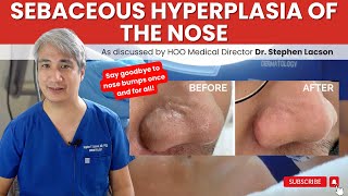 DERMATOLOGIST EXPLAINS HOW TO TREAT NOSE BUMPS DUE TO SEBACEOUS HYPERPLASIA [upl. by Berk]