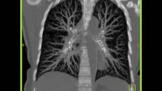 Lung Anatomy Normal Lung Vasculature [upl. by Ahsam812]