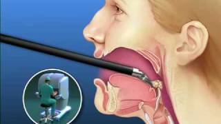 Robotic Tongue Cancer Surgery  Mayo Clinic [upl. by Gemperle]