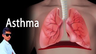 Asthma क्या हैं  what is the Asthma  causes symptoms and treatment  Hindi English दोनों में 🔥😲 [upl. by Enitsej]