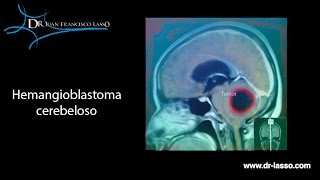 Hemangioblastoma cerebeloso [upl. by Suixela]