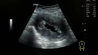 Endometrial carcinoma ultrasound [upl. by Lednahs979]