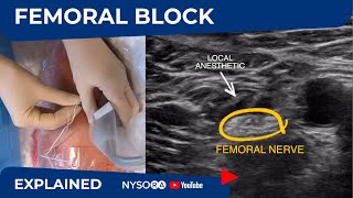 UltrasoundGuided Femoral Nerve Block  Regional anesthesia Crash course with Dr Hadzic [upl. by Ahsain]